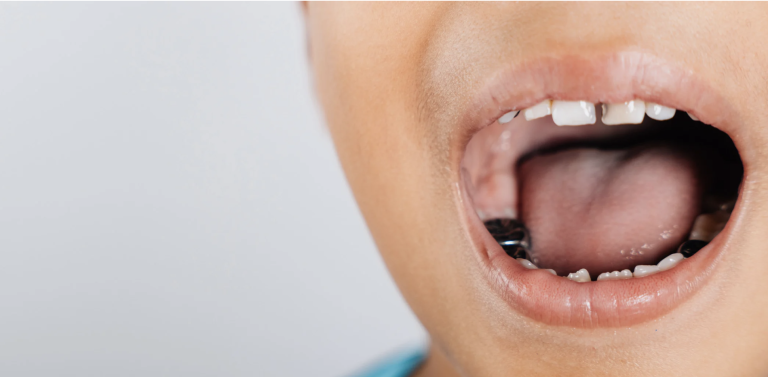 Paslanmaz Çelik Kronlar: Çocukların “Prenses Taçları” ve “Demir Adam Dişleri”